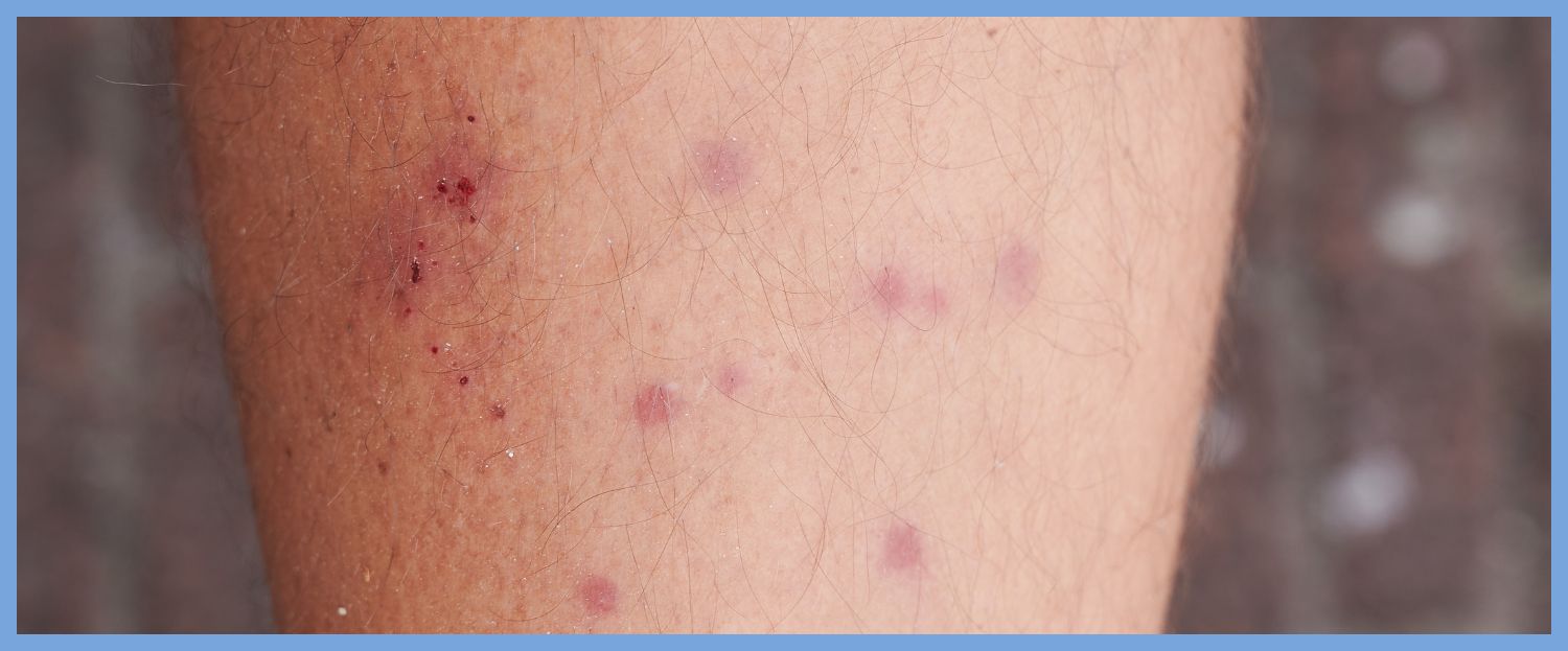 What Do Chigger Bites Look Like On Humans